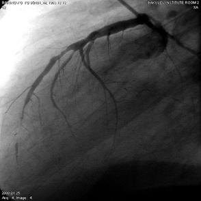 Трансмиокардиальная лазерная реваскуляризация в сочетании с методами прямой реваскуляризации у больных с ишемической болезнью сердца